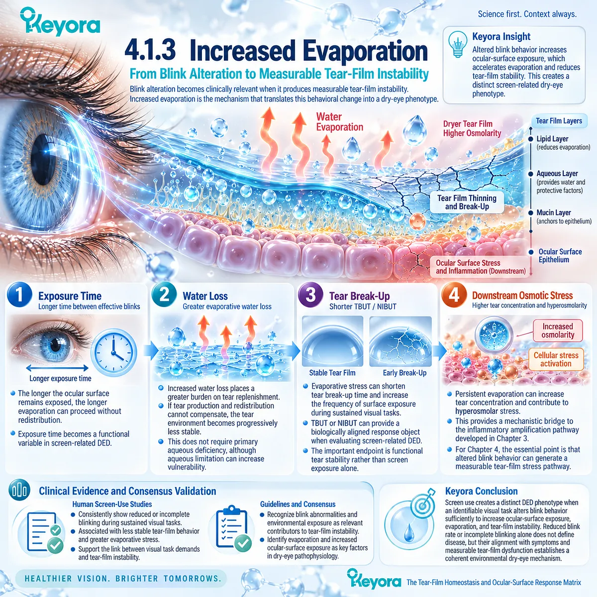 Screen-related dry eye links increased evaporation to tear water loss, shorter TBUT and hyperosmolar stress, mapped by Keyora’s Tear-Film Homeostasis and Ocular-Surface Response Matrix. Screen-related dry eye links increased evaporation to tear water loss, shorter TBUT and hyperosmolar stress, mapped by Keyora’s Tear-Film Homeostasis and Ocular-Surface Response Matrix.