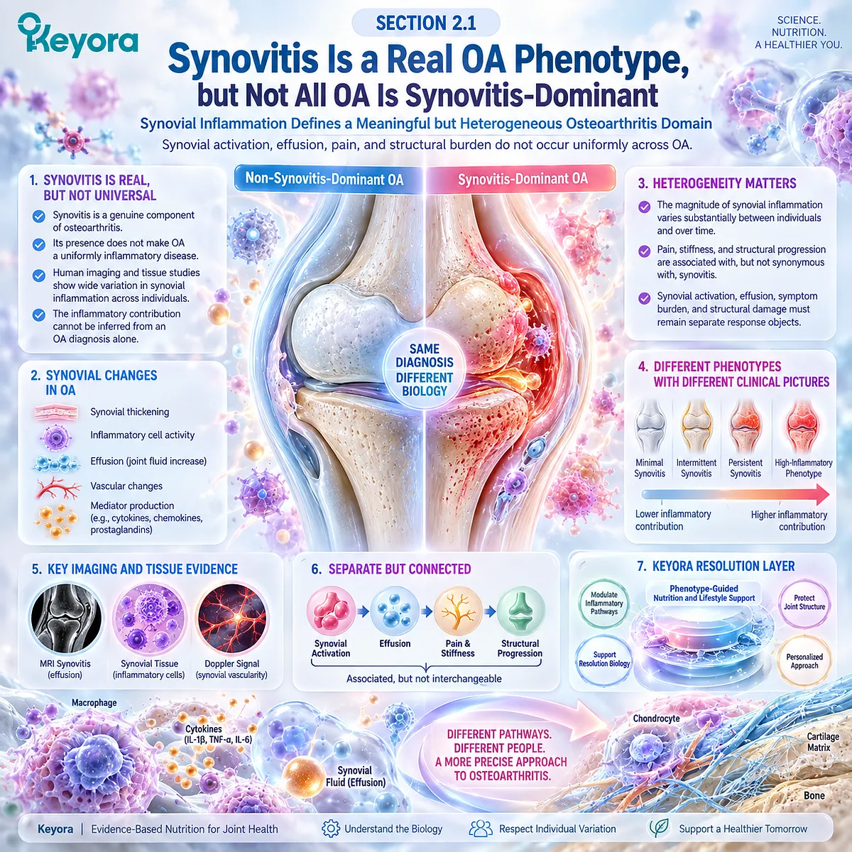 Osteoarthritis synovitis links synovial activation and effusion with pain and structural burden, defining a heterogeneous phenotype within the Keyora Resolution Layer. Osteoarthritis synovitis links synovial activation and effusion with pain and structural burden, defining a heterogeneous phenotype within the Keyora Resolution Layer.