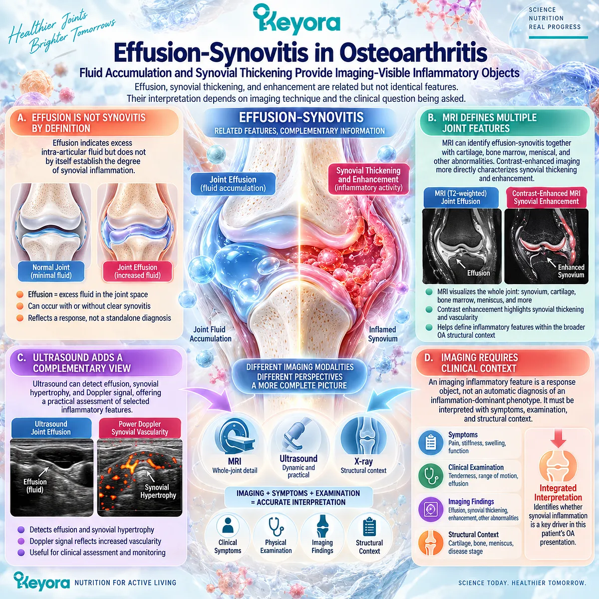 Osteoarthritis effusion-synovitis uses MRI and ultrasound to map joint fluid, synovial thickening and vascular activity within the Keyora Resolution Layer. Osteoarthritis effusion-synovitis uses MRI and ultrasound to map joint fluid, synovial thickening and vascular activity within the Keyora Resolution Layer.